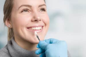 dental veneers sandy