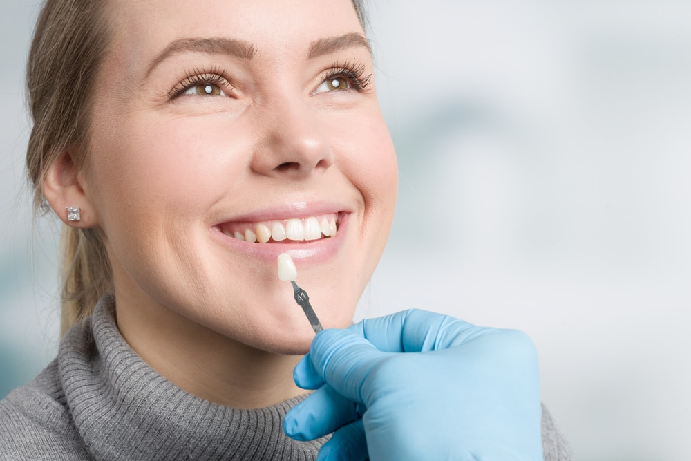 dental veneers sandy